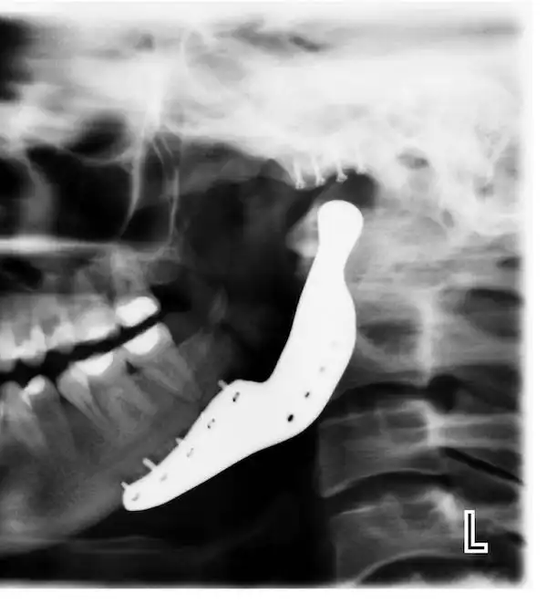 Implant indywidualny żuchwy zdjęcie rtg