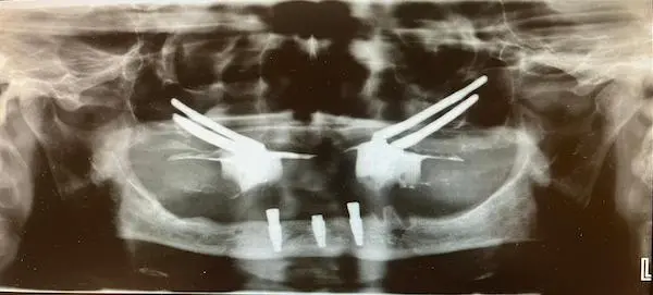 Implanty jarzmowe na zdjęciu panoramicznym