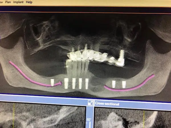 CBCT implantów zębowych wykonane w Cime w Tychach