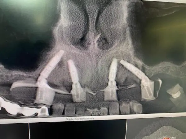Zdjęcie panoramiczne implantów zębowych w Tychach