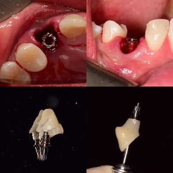 Prace wykonane na implantach zębowych w Cime Tychy