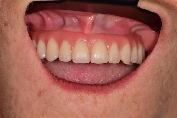 Praca na implantach zębowych w Cime Tychy