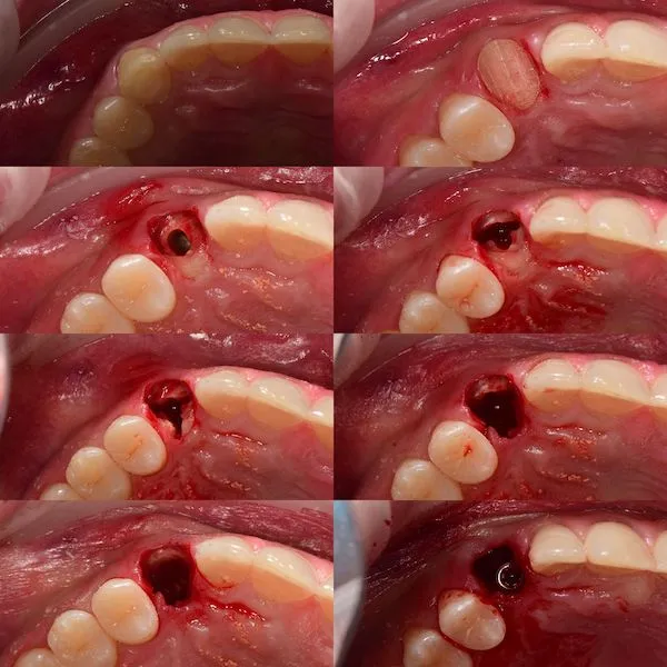 Cała procedura wprowadzenia implantów zębowych w Cime Tychy