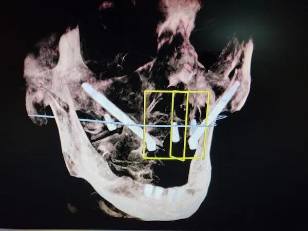 Implanty zygomatyczne jarzmowe wprowadzone w centrum implantologii cime