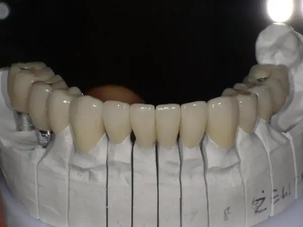 Praca protetyczna na implantach zębowych w gabinecie Cime Tychy